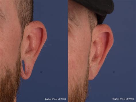 Earlobe Repair Before And After 04 Weber Facial Plastic Surgery
