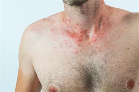 Vancouver Cherry Angioma Removal Red Spots Removal In Surrey