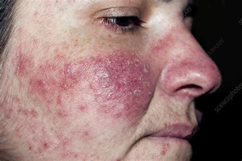 Acne Rosacea Stock Image C0024052 Science Photo Library
