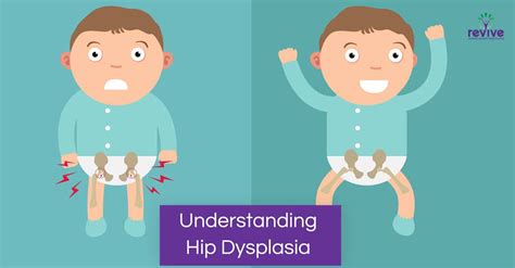 Understanding Hip Dysplasia Revive Physio Therapy And Pilates