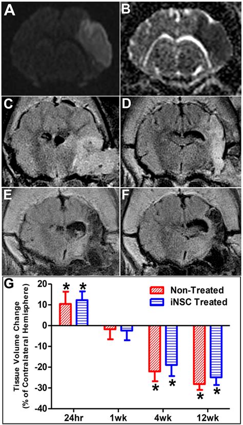 Ischemic Stroke Results In Significant Brain Swelling And Atrophy Mri