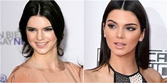 Cirugías de Kendall Jenner (+Antes y Después) - Cirugias.de