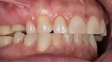 Bruxismo o rechinar los dientes - Dentista de Urgencias