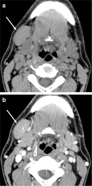 A 44 Year Old Man With Primary Igg4 Related Cervical Lymphadenopathy