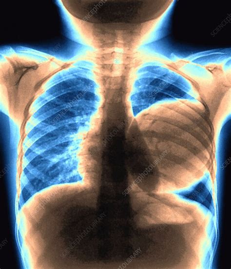 Cyst In A Lung Chest X Ray Stock Image M1700283 Science Photo