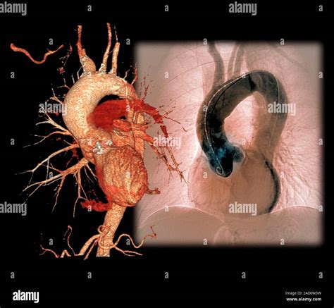 Aortic Aneurysm In Hypertension Coloured Angiogram Right And 3d
