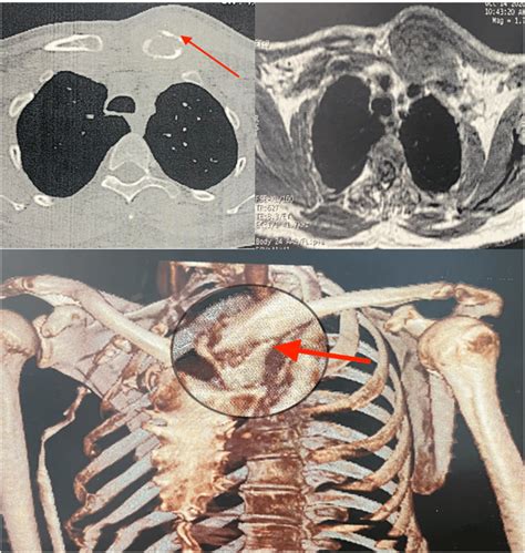 Ct Scan And Mri Showing An Appearance Compatible With Clavicle Mass