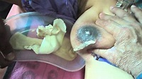 BREAST ABSCESS . - YouTube