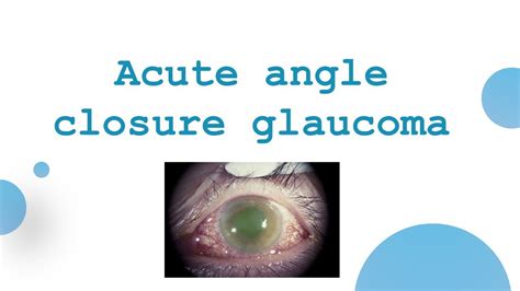 Acute Angle Closure Glaucoma Usmle Plab Amcukmla Youtube