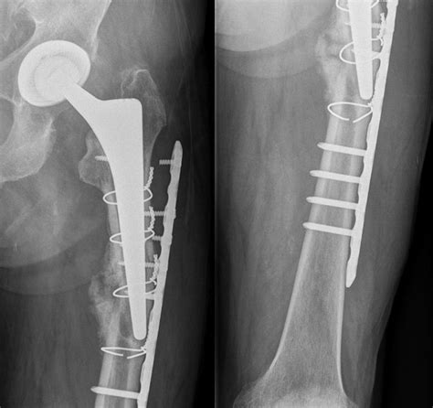 Hip Revision Arthroplasty For Failed Osteosynthesis In Periprosthetic