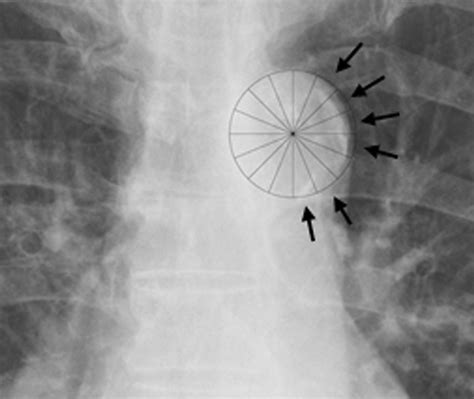 Measurement Of The Aortic Arch Calcification Score Aoacs Using Plain