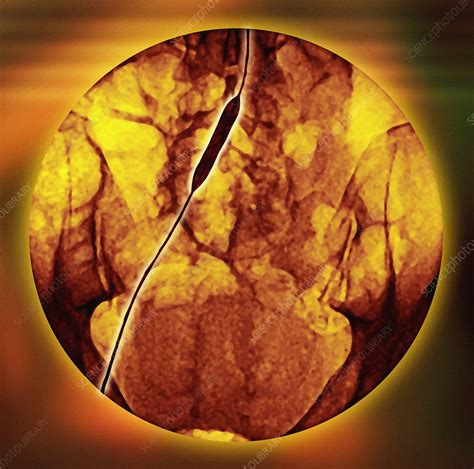 Iliac Artery Angioplasty Angiogram Stock Image F0012995 Science