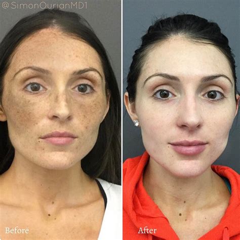 How To Fix Facial Discoloration Causes And Treatments Heidi Salon