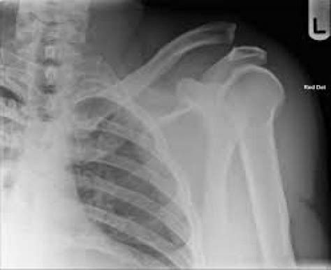 Ac joint separations are common in the ed. Ski Injury Spotlight: AC Separation - Blog | Nepean Sports ...