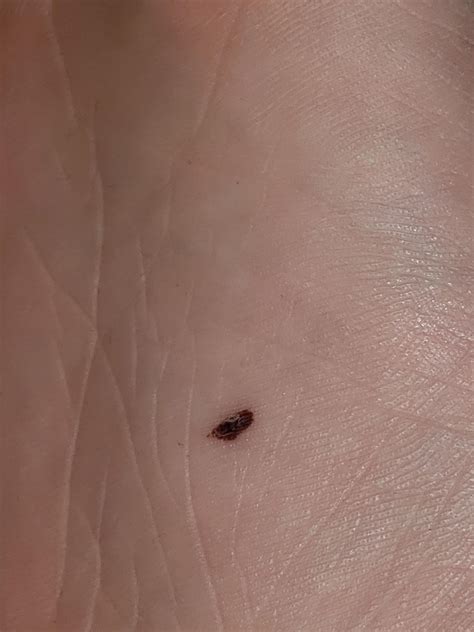 Im A Healthy 16 M With A Brownred Spot On The Sole Of My Foot That