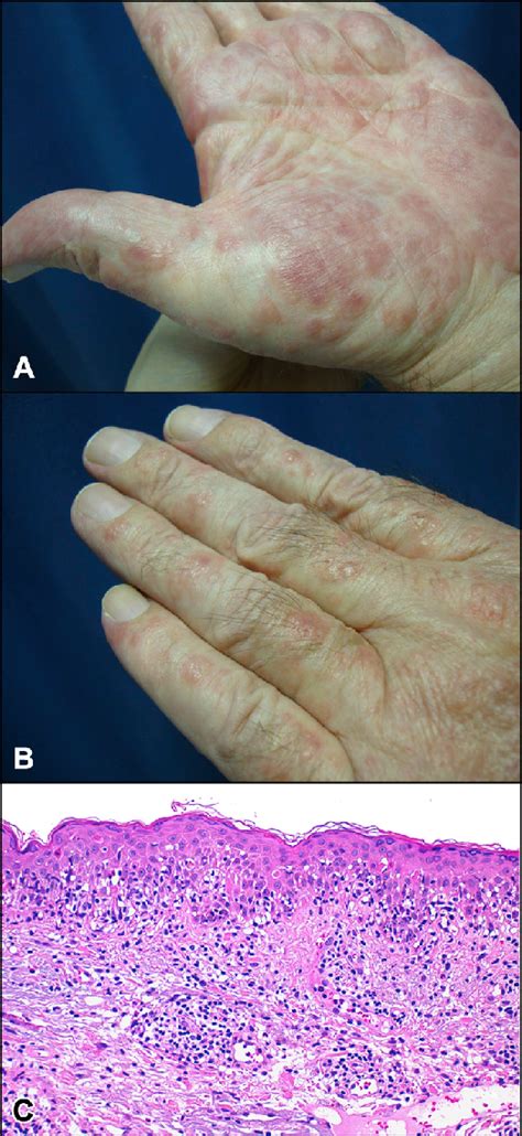 Photo Induced Erythema Multiforme A And B Targetoid Lesions On Both