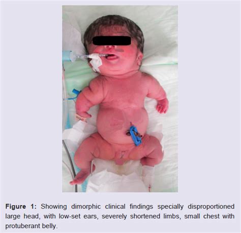 Avens Publishing Group An Osteogenesis Imperfecta Type Ii A In A Female Newborn A Case Report