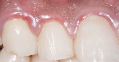 Swollen Gums Causes Treatments And Home Remedies