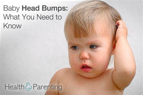 Baby Head Bumps What You Need To Know Head Bump Baby Bumped Head