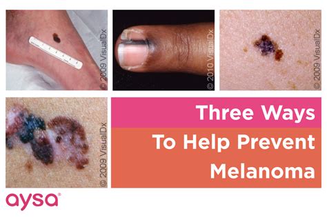 Three Ways You Can Help Prevent Melanoma Ask Aysa