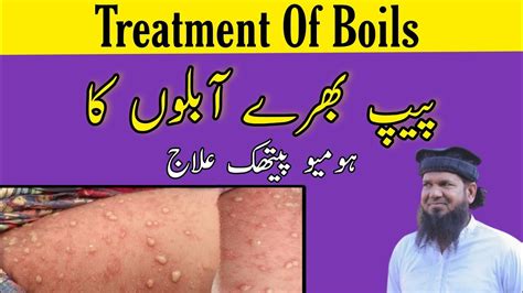 Pus Filled Boils Treatment Of Boils Psoriasis Ki Homeopathic