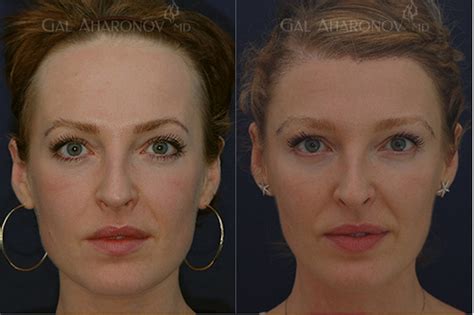 Temple And Forehead Filler Plastic Surgery