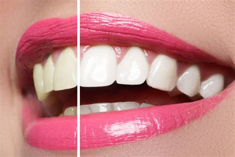 Best Tooth Whitening Stock Photos Pictures And Royalty Free Images Istock