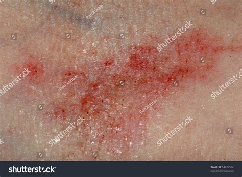 Allergic Rash Dermatitis Skin Patient Stock Photo 54433522 Shutterstock