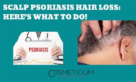 Scalp Psoriasis Hair Loss Heres What To Do Cosmeticium