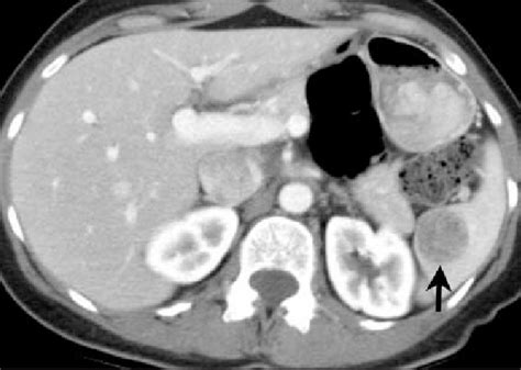 Contrast Enhanced Ct At The Level Of The Spleen Reveals An Enhancing