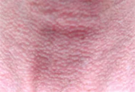 Lupus Rash Types Effects Diagnoses Treatments Prevent