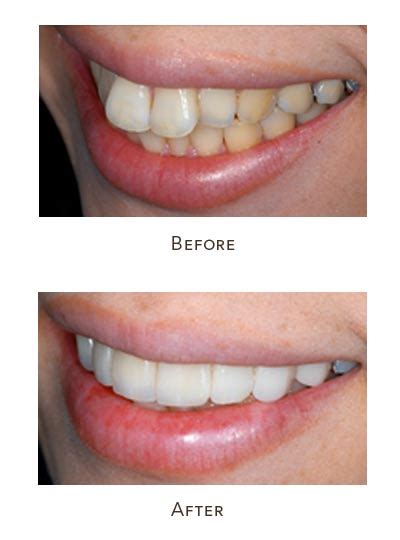 Veneers Before And After Buck Teeth