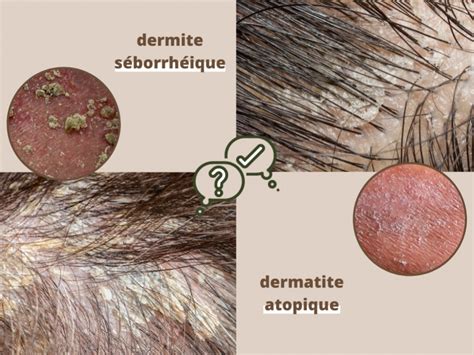 La Différence Entre Une Dermite Séborrhéique Dune Dermatite Atopique