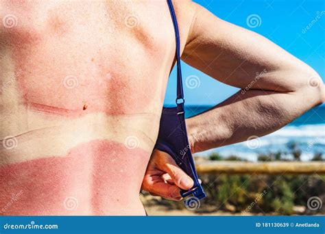 Woman Back Skin Hurt From Sun Burn Stock Image Image Of Summer