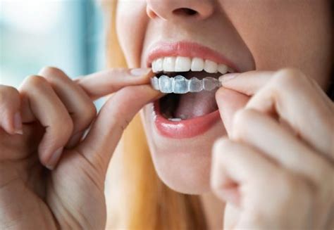 Orthodontics Warsaw In Invisalign Clear Braces Cosmetic Dentist