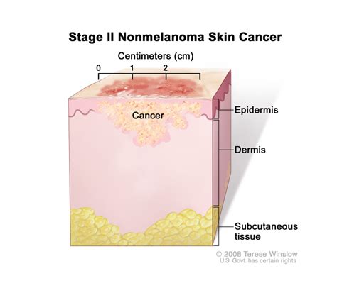 Figure Stage Ii Nonmelanoma Skin Cancer The Tumor Is More Than 2