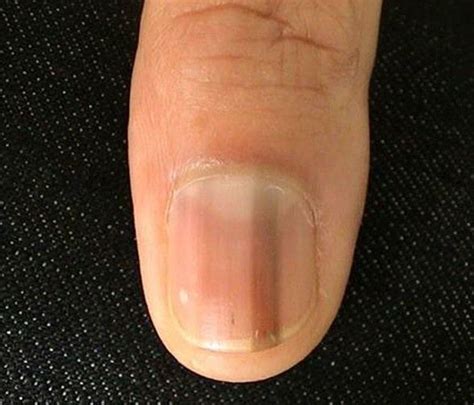 Ridges are among the different kinds of nail abnormalities that can develop due to aging, nail injury, or trauma, or underlying medical conditions. Why does a brown line appear on a fingernail? - Quora