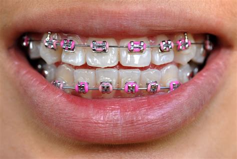 Colorful Braces Dudley Smiles Orthodontics