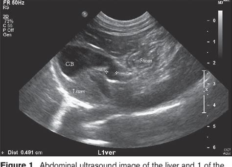 Figure 1 From Congenital Duplex Gallbladder And Biliary Mucocele