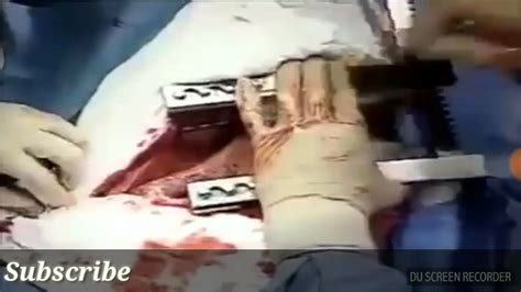 Understandably, this can terrify women. Lung Cancer Removal Surgery of Lower Lobe Live ...