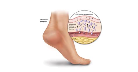 Foot Swelling Heel That Pain