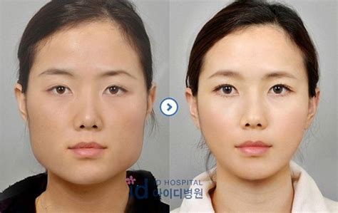 Crazy Before And After Photos Of South Korean Plastic Surgery Page 5