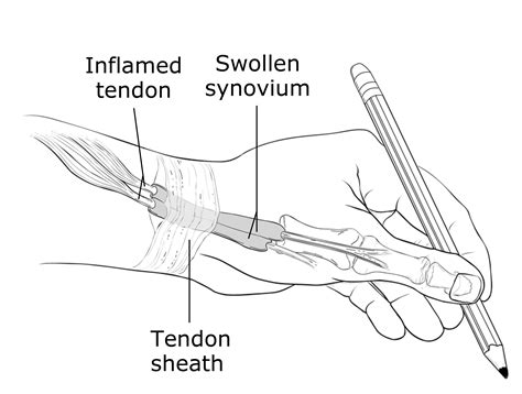Wrist Tendonitis Swelling