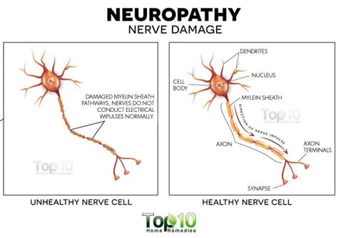 Top 10 Nerve Disorders Ideas And Inspiration