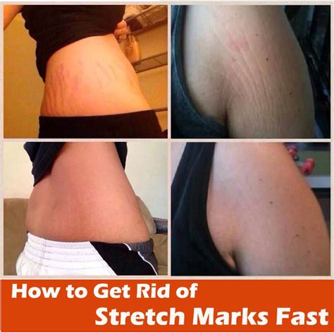 How To Get Rid Of Stretch Marks Fast Spa Pinterest Health Eggs