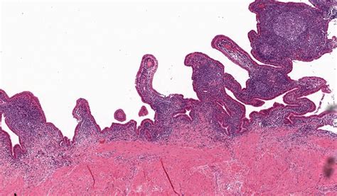 Pathology Outlines Follicular Cholecystitis