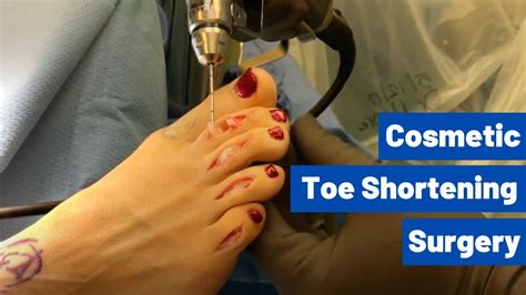 How Does Toe Shortening Surgery Work