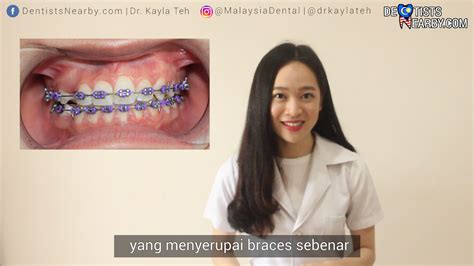 Fake Braces Itu Berbahaya Selain Daripada Penjejasan Kesihatan Mulut Ia Juga Akan Meningkatkan