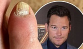 Chris Pratt believed to be dealing with toe fungus as celeb doctor ...