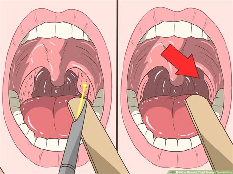 Aid V Px Remove Tonsil Stones Tonsilloliths Step